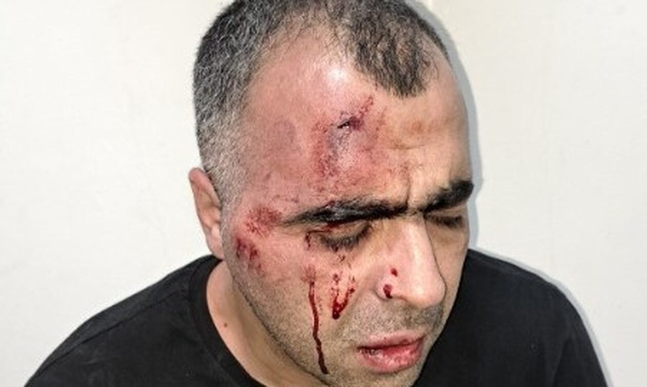 Τουρκία: Δημοσιογράφος έπεσε θύμα άγριου ξυλοδαρμού από σωματοφύλακες δημάρχου