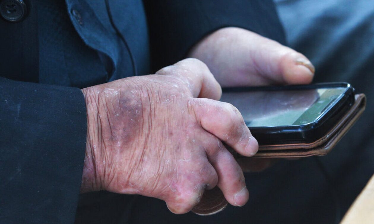 Συναγερμός στις ΗΠΑ: Επανεμφανίστηκε η λέπρα – Θα μπορούσε να γίνει ενδημική στη Φλόριντα