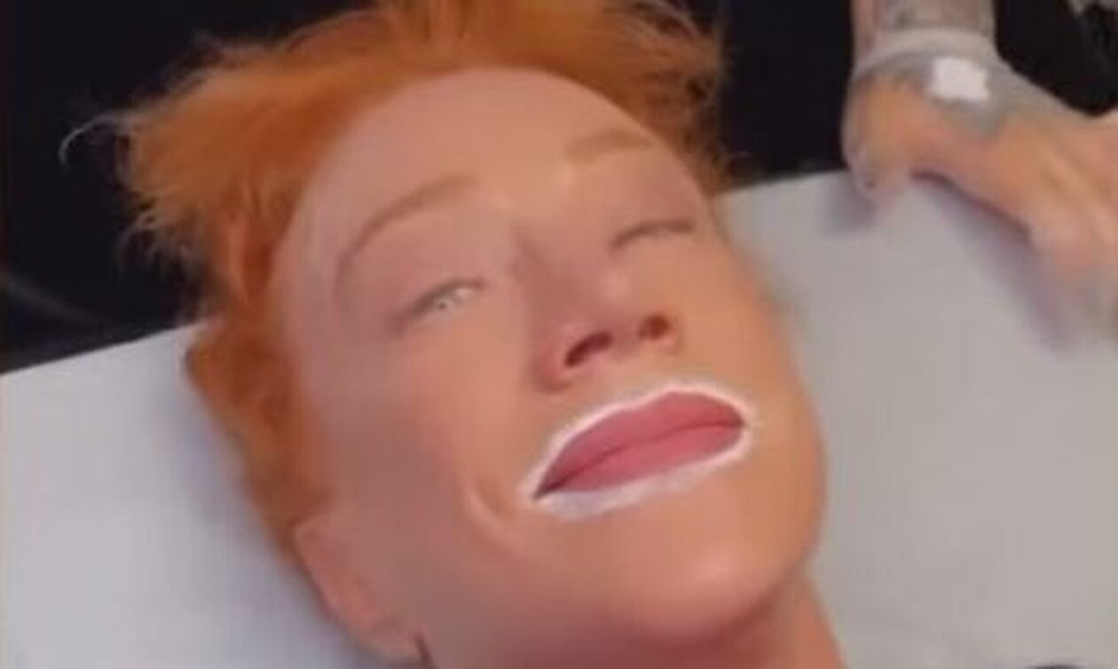 «Είμαι χάλια» – Κωμικός δείχνει τα πρησμένα από τατουάζ χείλη της