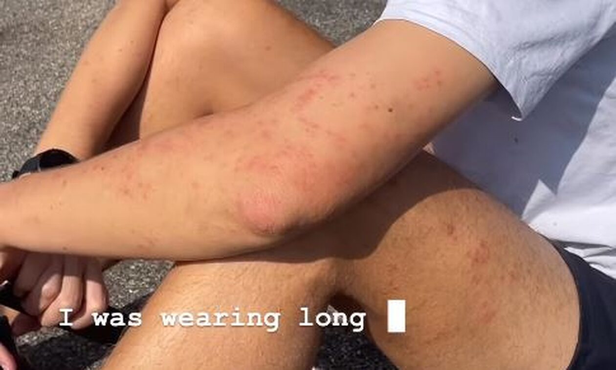 Γερμανία: Εφιάλτης για ζευγάρι τουριστών από την Αυστραλία – Τους δάγκωσαν κοριοί μέσα σε τρένο