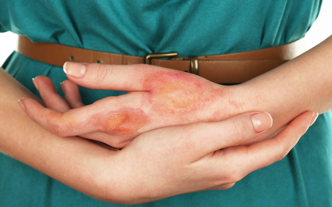 Πανελλήνια Ημέρα Πρόληψης Εγκαυμάτων: Το έγκαυμα είναι κοντά μας και μας αφορά όλους