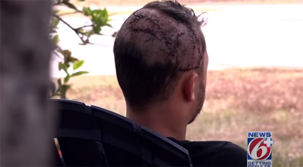 Tεράστιος αλιγάτορας άρπαξε άνδρα από το κεφάλι: Πως κατάφερε να ξεφύγει