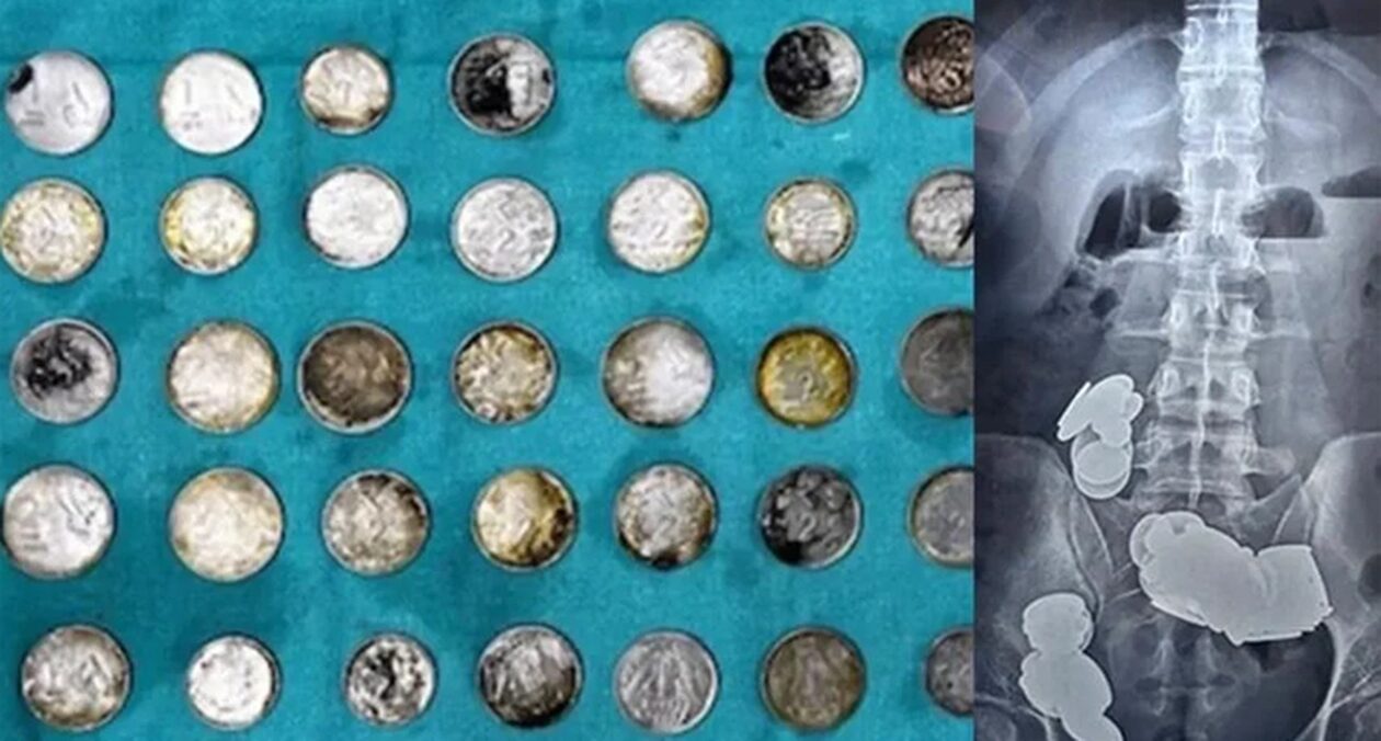 Κατάπιε κέρματα και μαγνήτες για να «χτίσει» σώμα: Άκουσε ότι ο ψευδάργυρος βοηθάει στο bodybuilding