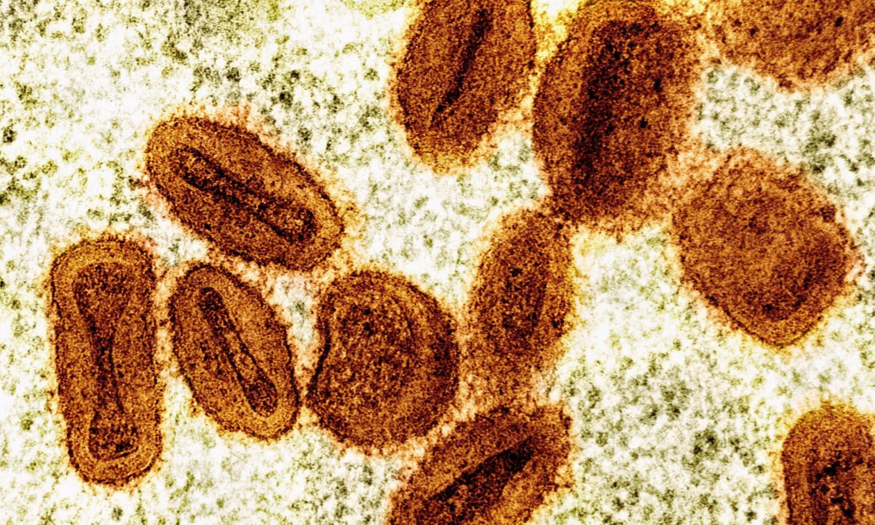 Mpox: Ασθενής περιγράφει τα επώδυνα συμπτώματα – «Δεν μπορούσα να κοιμηθώ από τον πόνο»