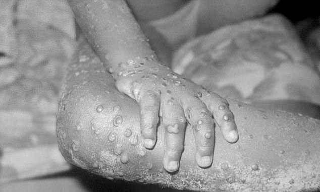 Ευλογιά των Πιθήκων: Έκτακτη συνεδρίαση του ΠΟΥ
