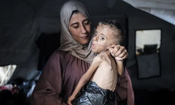 Διορθώνουν οι New York Times: Ο υποσιτισμένος μικρός Μοχάμεντ από τη Γάζα «έχει και άλλη πάθηση»