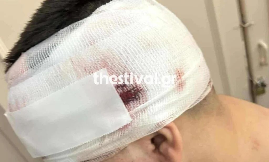 Θεσσαλονίκη: 11 τα άτομα που επιτέθηκαν στον 13χρονο – Χειρουργήθηκε και παραμένει στο νοσοκομείο