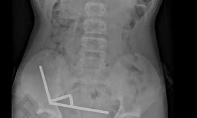 Νέα Ζηλανδία: 13χρονος κατάπιε 100 μαγνήτες υψηλής ισχύος – Γιατροί αφαίρεσαν μέρος του εντέρου του