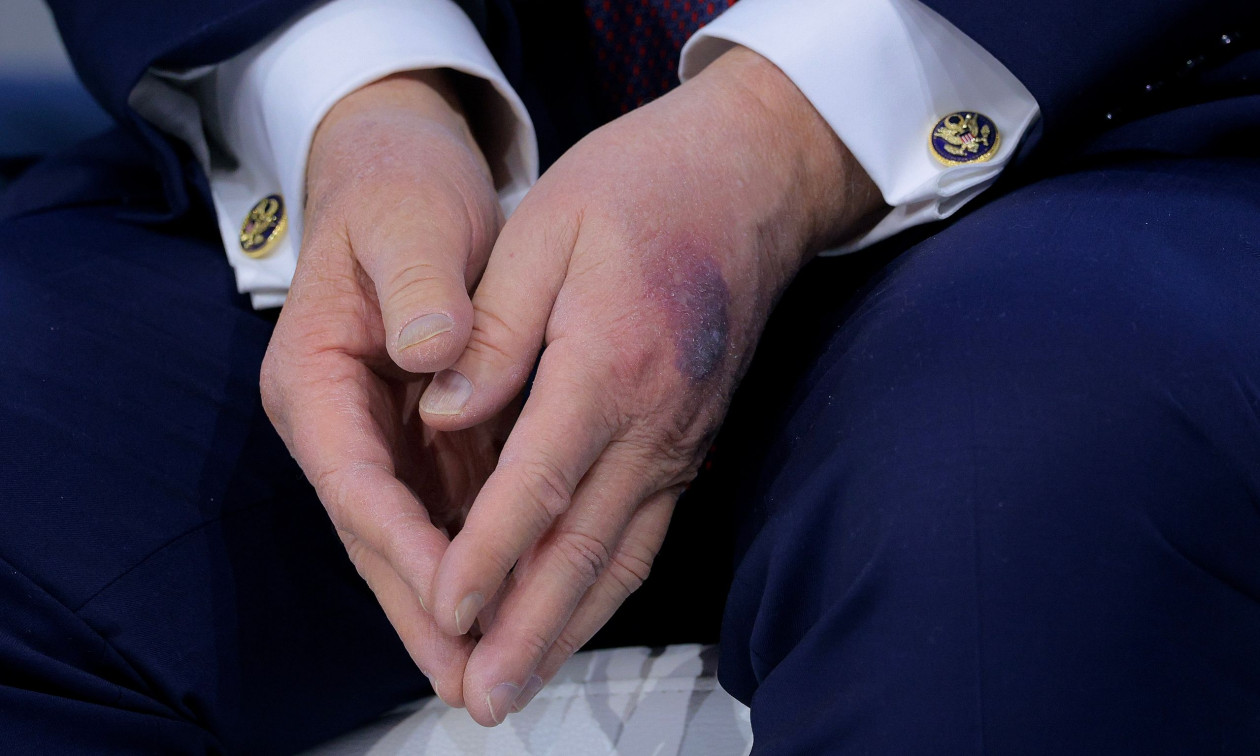 Φουντώνουν πάλι οι φήμες για την υγεία του Τραμπ: Εμφανίστηκε με μελανιές στο χέρι στο Νταβός