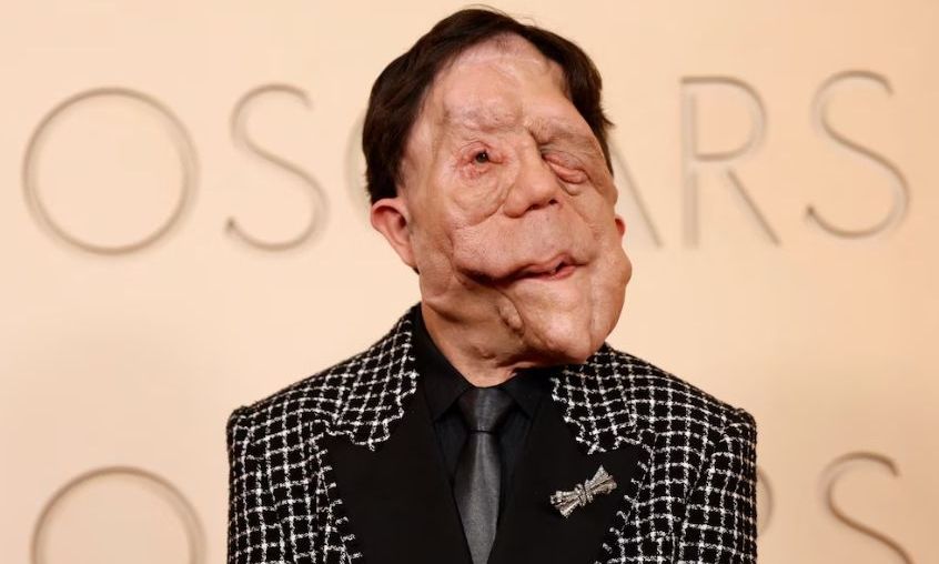 Άνταμ Πέρσον: Συγκλόνισε στο κόκκινο χαλί των Όσκαρ – Η μάχη του με την νευροϊνωμάτωση