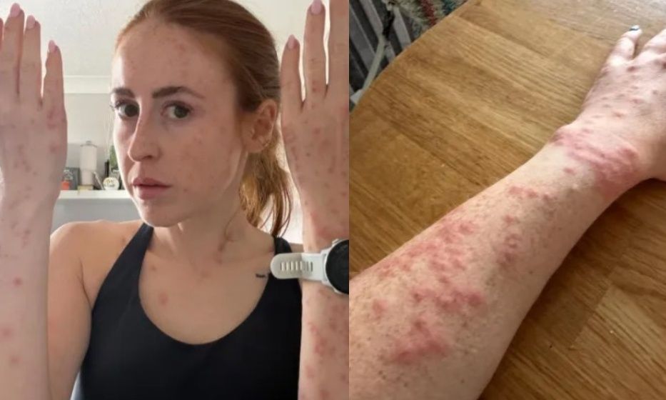 Influencer γέμισε με σημάδια από τσιμπήματα κοριών σε όλο της το κορμί – «Έπαθα κρίση πανικού»