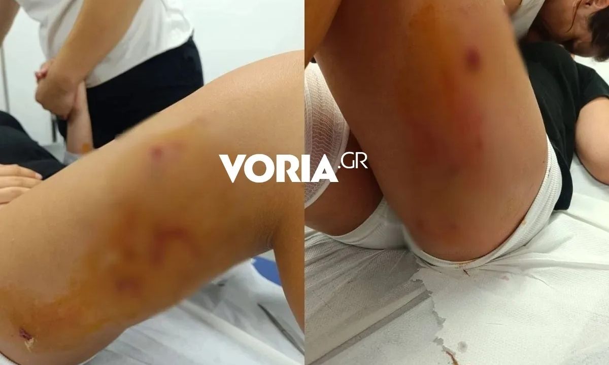 Θεσσαλονίκη: Στιγμές τρόμου για 12χρονη που δέχθηκε επίθεση από αγέλη σκυλιών